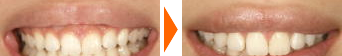 歯ぐきの整形の写真